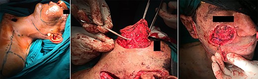 Patient #2 intraoperatively.