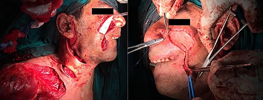 Patient #2 reconstruction.