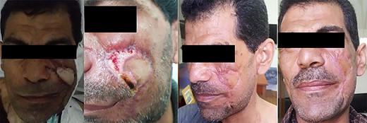 Patient #2 recovery.