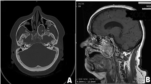 (A and B) Preoperative scan (A-axial CT scan, B-sagittal MRI scan). Multi-sliced CT and MRI scan revealed a destructive mass 4 × 5 cm in the posterior third of the left nasal cavity, left ethmoid and left maxillary sinus spreading into nasopharynx predominantly on patients left side, but occluding both choanae (tumor in white oval). Tumor spread included left great wing of the sphenoid bone, along the left petroclival fissure and the apex of the left temporal bone.