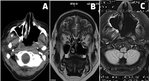 (A–C) Postoperative scans. (A) An early postoperative PET CT scan shows tumor margins and postoperative sinonasal cavity. (B and C) MRI scans of patients free of local tumor recurrence and distant tumor spread at 24 months (B) and 36 months (C) of regular postoperative follow-up.