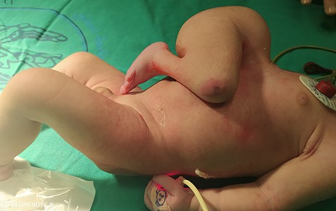 Image of heteropagus twins.