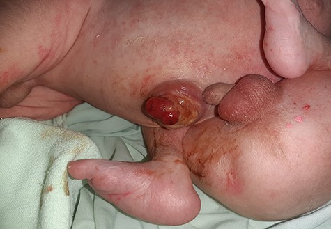 Image of heteropagus twins having omphalocele.