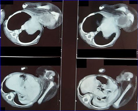 Contrast-enhanced CT scan image showing parasite’s viscera and bony parts.