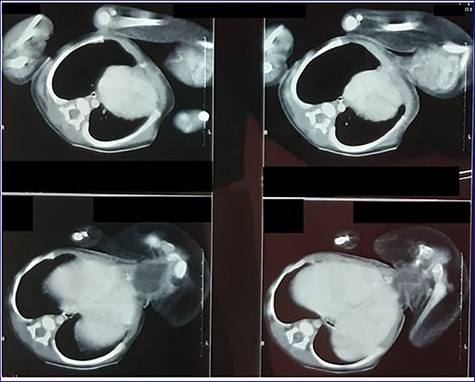 Contrast-enhanced CT scan image showing parasite’s viscera and bony parts.