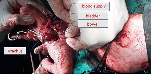 Operative picture showing blood supply and the bladder of parasite.