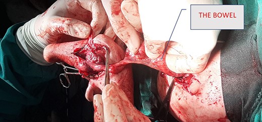 Operative picture showing the bowel of parasite.