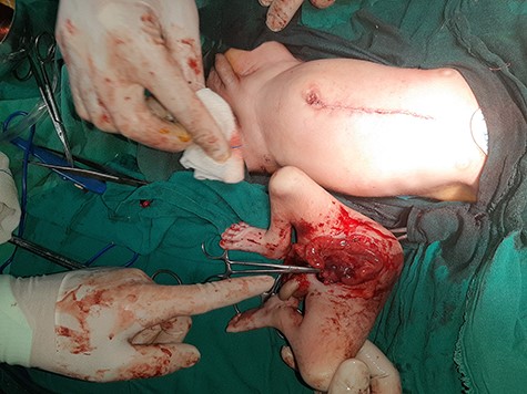 Postoperative aspect excised specimen of parasite twin.