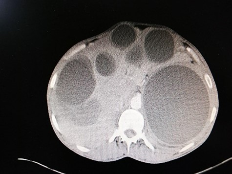 Abdominal CT scan reveals: six rounded homogenous low-density cysts in the liver, measuring from 0.15 to 0.17 m. A large rounded cyst in the spleen, containing multiple peripheral small vesicular cysts.