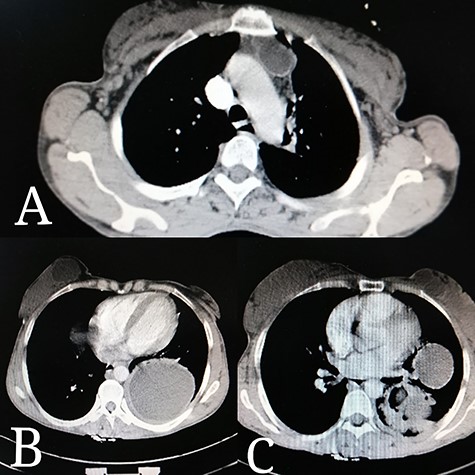 Thoracic CT scan reveals: (A) a 0.03 × 0.07 m cyst in the upper mediastinum, adjacent to the aortic arch. (B) A rounded cyst in the right breast. (C) Few rounded cysts in the left breast. (B, C) Two rounded homogenous cysts in the lower lobe of the left lung, measuring 0.17 × 0.17 m.