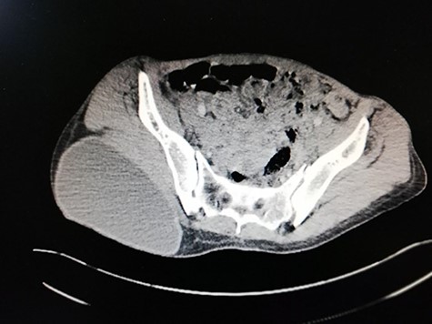 Pelvic CT scan reveals: a large oval homogenous cyst, above the right gluteal muscles, measuring 0.2 × 0.13 m.