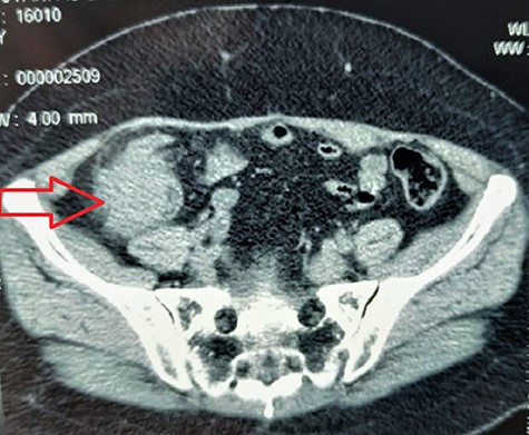Axial CT scan showing the intra-caecal mass (red arrow).