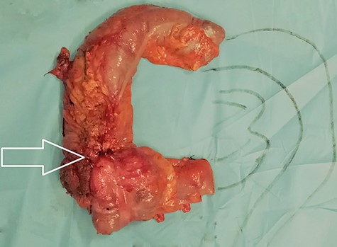 Surgical specimen of the resected right colon with the tumor (white arrow).