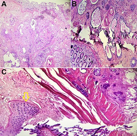 Microscopic findings: (A and B) the colon mass was composed of well-differentiated squamous carcinoma cells; (C) tumor cells are voluminous rounded anisocytosis marked with basophile cytoplasm with blurred contours (yellow arrow); hematoxylin and eosin staining; magnification ×100.