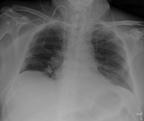Portable chest X-ray with no pleural effusion after placement of pigtail pleural drain.