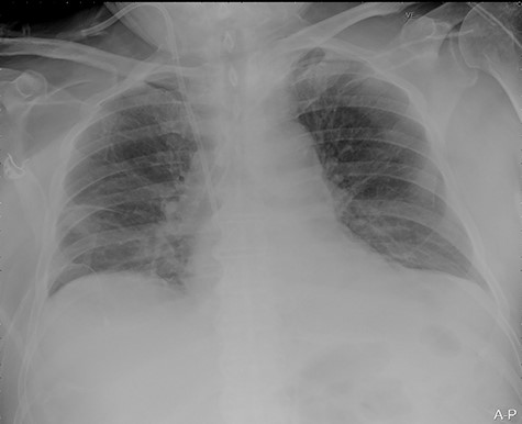 Portable chest X-ray in half-upright position showing haemothorax 4 h after placement of pigtail pleural drain.