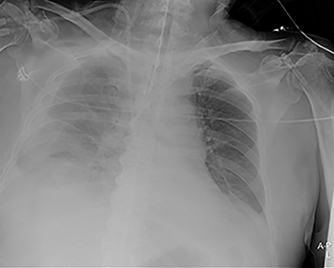 Portable chest X-ray in half-upright position showing massive haemothorax despite chest tube.