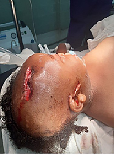 A 2-year-old female patient with hyena bite to the head resulting in a compound depressed skull fracture.