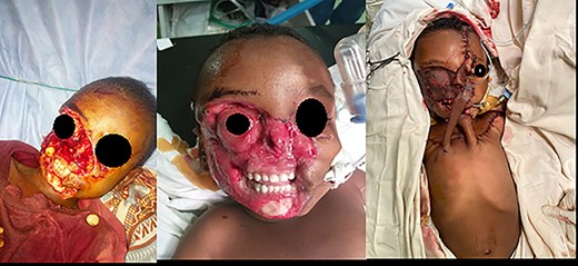 A 4-year-old male patient with hyena bite to the face resulting in loss of nose, eyelids, cheek and lips.