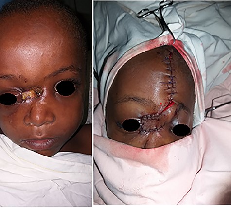 A 9-year-old male patient with hyena bite to the face resulting in exposed nasal bone.