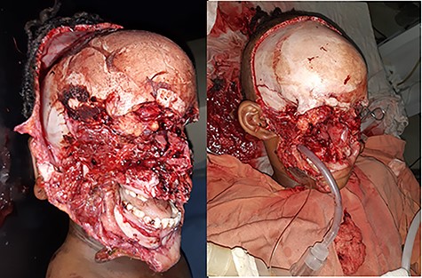 An 8-year-old female patient with hyena bite to face, eyes, nose and scalp.