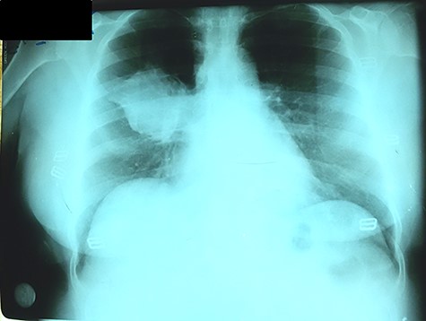 CXR with heterogeneous density with irregular borders in the right lung.