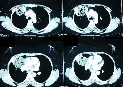 Thoracic CT-scan with the heterogenous mass having necrosis and gas bubbles (arrows).
