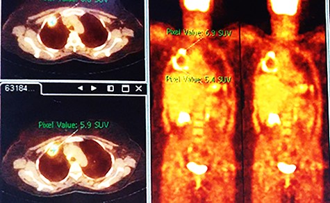 PET-scan with the mass having multiple SUV values.