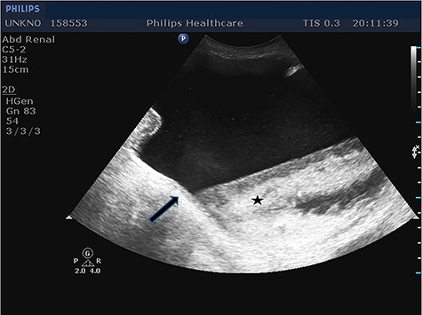 Longitudinal ultrasound image of the inguinal canal revealed a hernia that contained the entire urinary bladder. Notice the urothelium (arrow), as well as a great amount of debris (star).