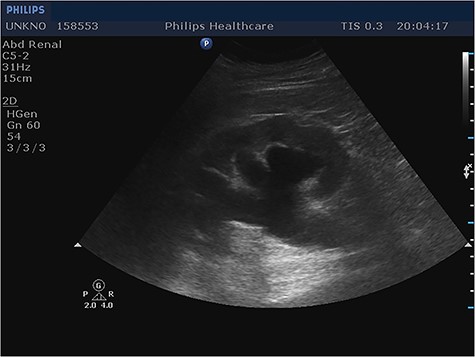 Longitudinal ultrasound image of right kidney showed hydronephrosis. Same findings noticed in contralateral kidney (not shown).