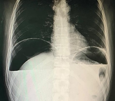Chest X-ray showing air under the diaphragm.
