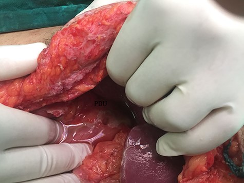 2-cm ulcer appeared on the anterior aspect of the first part of the duodenum.