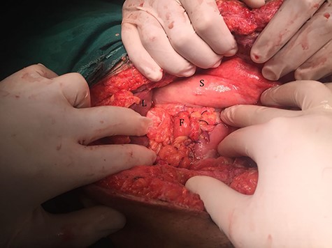 Duodenal ulcer after repair using falciform ligament.