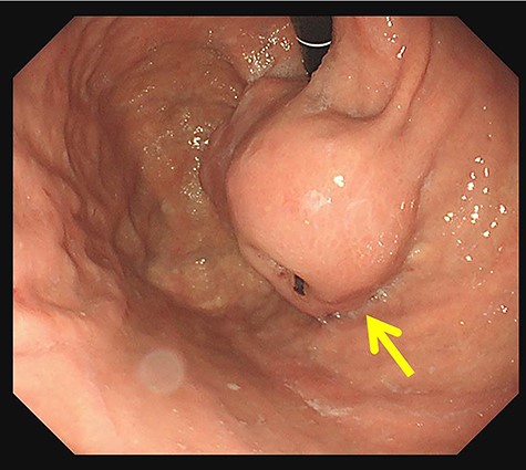 In upper gastrointestinal endoscopy, the tumor looked like a submucosal tumor with delle at the lesser curvature of the cardia (arrow).