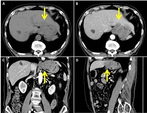 In abdominal enhanced computed tomography, a slightly low-density tumor of about 70 mm in diameter at the cardia (arrow) was seen. It appeared to infiltrate into the liver directly. (A: plane; B: axial image in the artery phase; C: coronal image in the artery phase; D: sagittal image in the artery phase)