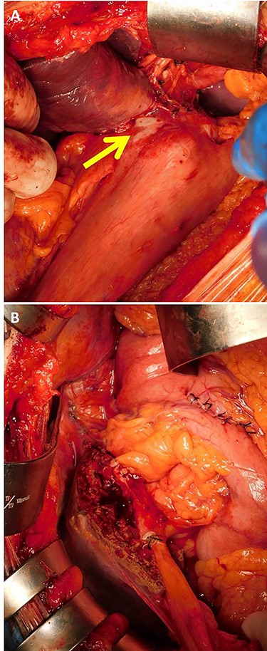 Intraoperative findings showed that the tumor was located in the stomach wall of the cardia and was invading into the liver directly (A, arrow). Lateral hepatectomy, proximal gastrectomy, and lymphadenectomy were performed (B).