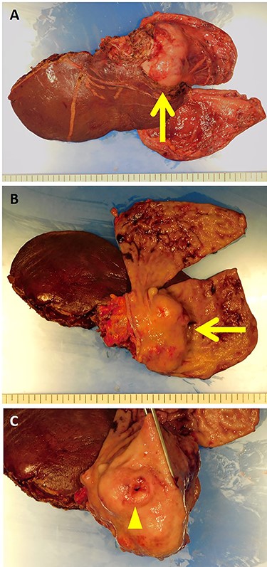 The resected specimen showed a white solid tumor continued from the left lateral liver to the stomach wall (A, arrow). Most of the tumor was found under the gastric mucosa (B, arrow). The tumor looked like a submucosal tumor with delle (C, arrowhead).