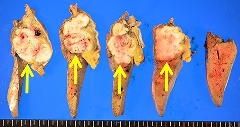 The tumor originated from the liver and showed extrahepatic growth (arrow).