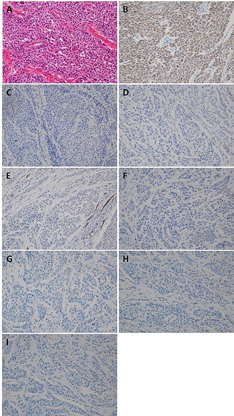 Pathological and immunostaining findings. (A) Hematoxylin–Eosin staining (×20): A poorly differentiated adenocarcinoma with unclear duct formation was detected. (B) AE1/AE3 staining (×20): positive. (C) CK20 staining (×20): negative. (D) CK7 staining (×20): negative. (E) CD34 staining (×20): negative. (F) c-kit staining (×20): negative. (G) CD56 staining (×20): negative. (H) synaptophysin staining (×20): negative. (I) chromogranin A staining (×20): negative.