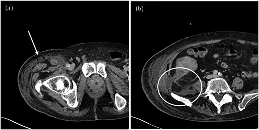 CT of the right hip with intravenous (IV) contrast.
