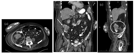 CT of the abdomen and pelvis with contrast IV and per os (PO).