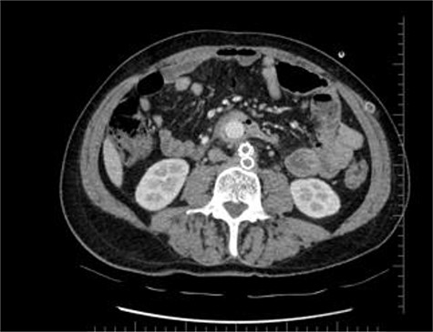 Axial section shows the two limbs of the EVAR, at the bottom. And on top of it, the Dacron straight graft part in the middle of the jejenum.