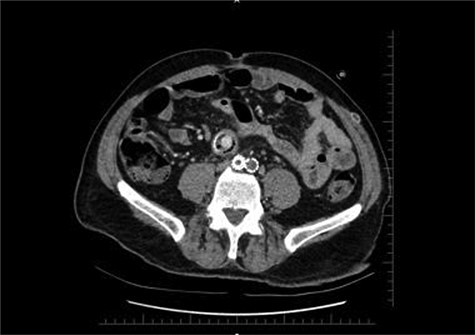 Distal CT axial section shows the two limbs of the EVAR, at the bottom. And on top of it, the Dacron straight graft part in the middle of the jejenum.
