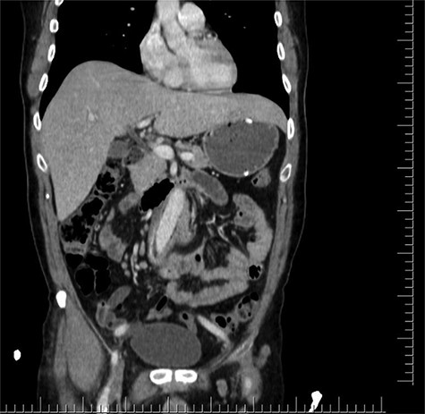 Coronal CT section shows straight part of the Dacron graft in the jejenum.