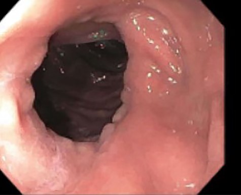 Esophagogastroduodenoscopy (EGD)–gastrojejunostomy, staple line, with no abnormal findings.
