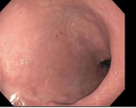 EGD–gastric pouch with no fistula identified.