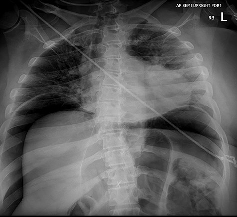Abdominal X-ray revealing massive pneumoperitoneum after endoscopy.