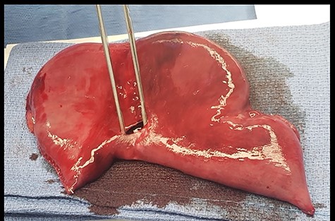 Resected specimen of jejuno-jejunal anastomosis with perforation.