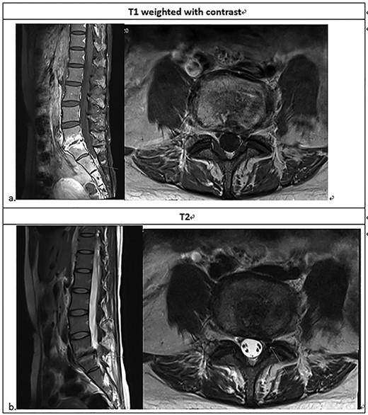 Lumbarsacral spine MRI (a) posterior bulging disc at L5-S1; extruding disc at the left subarticular zone of the left L5-S1, with compression of the left S1 nerve root; neural foraminal stenosis at left L5-S1; increased enhancement at L5-S1 related to the spondylitis change; (b) The arrow point at neural foraminal stenosis at left L5-S1.