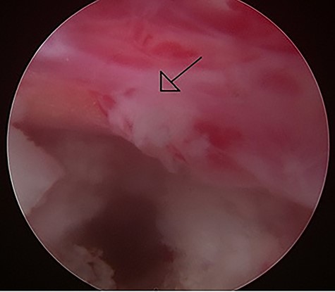 Intraoperative image of the percutaneous endoscopic interlaminar lumbar discectomy at the L5/S1 level left S1 root with hyperemic inflammation was noted after the protruding disc was removed.